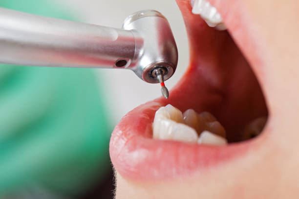 Best Emergency Tooth Extraction in Woodfield, SC